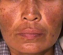 Melasma