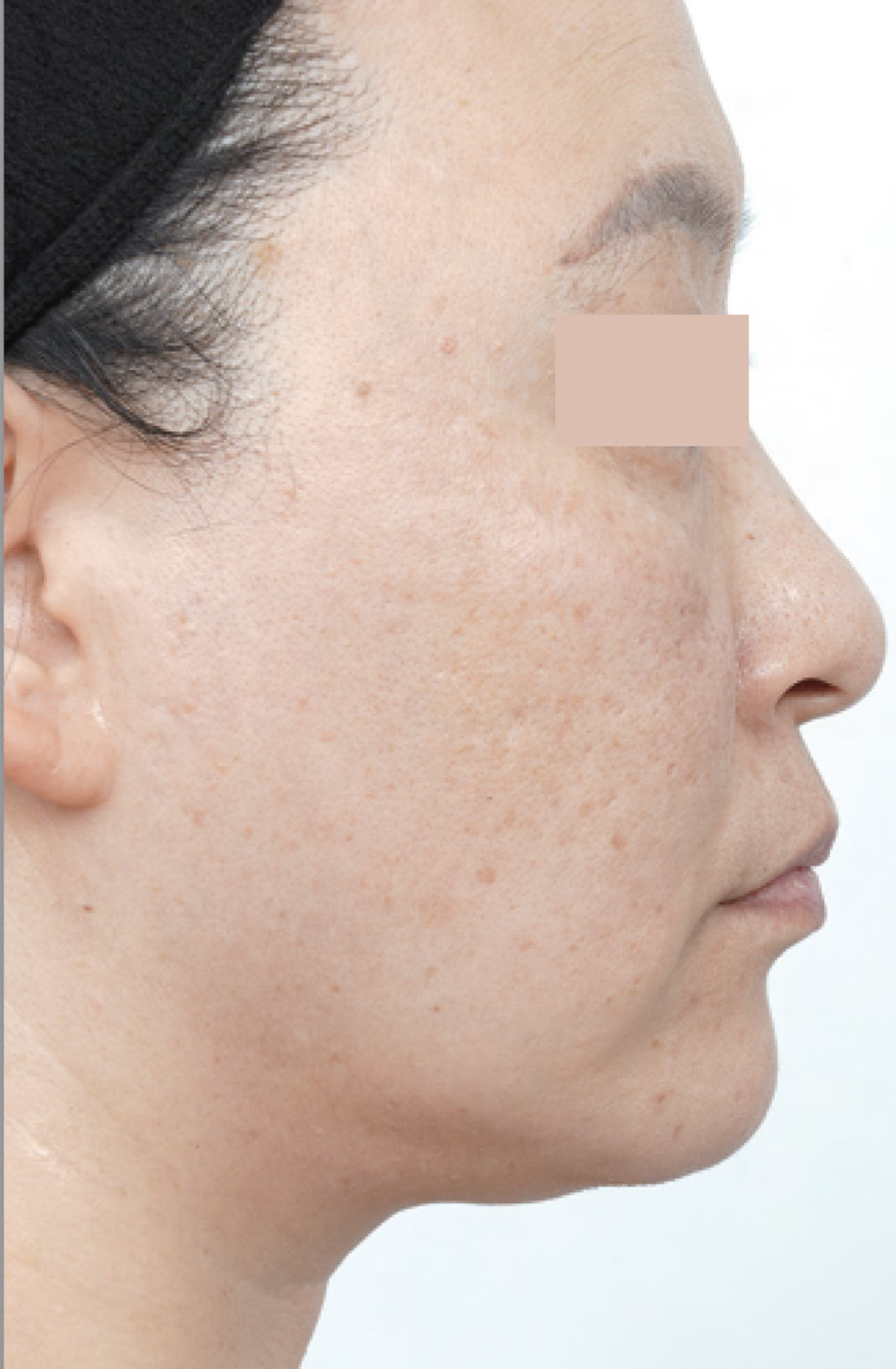 After EVERESSE Skin Tightening â€” right-side facial profile in the supplied treatment example