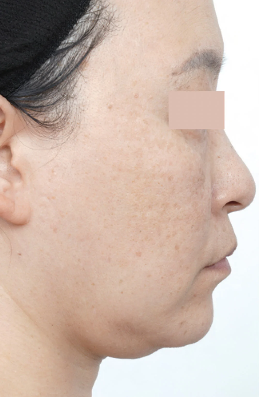 Before EVERESSE Skin Tightening â€” right-side facial profile in the same treatment example